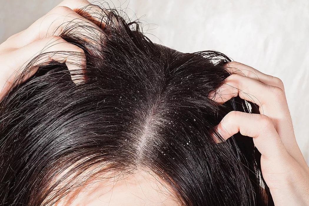 DRY SCALP: HOW TO GET RID OF IT?