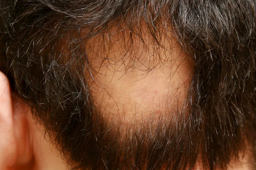 ALOPECIA AREATA: WHAT IS IT AND HOW DO YOU RECOGNIZE IT?