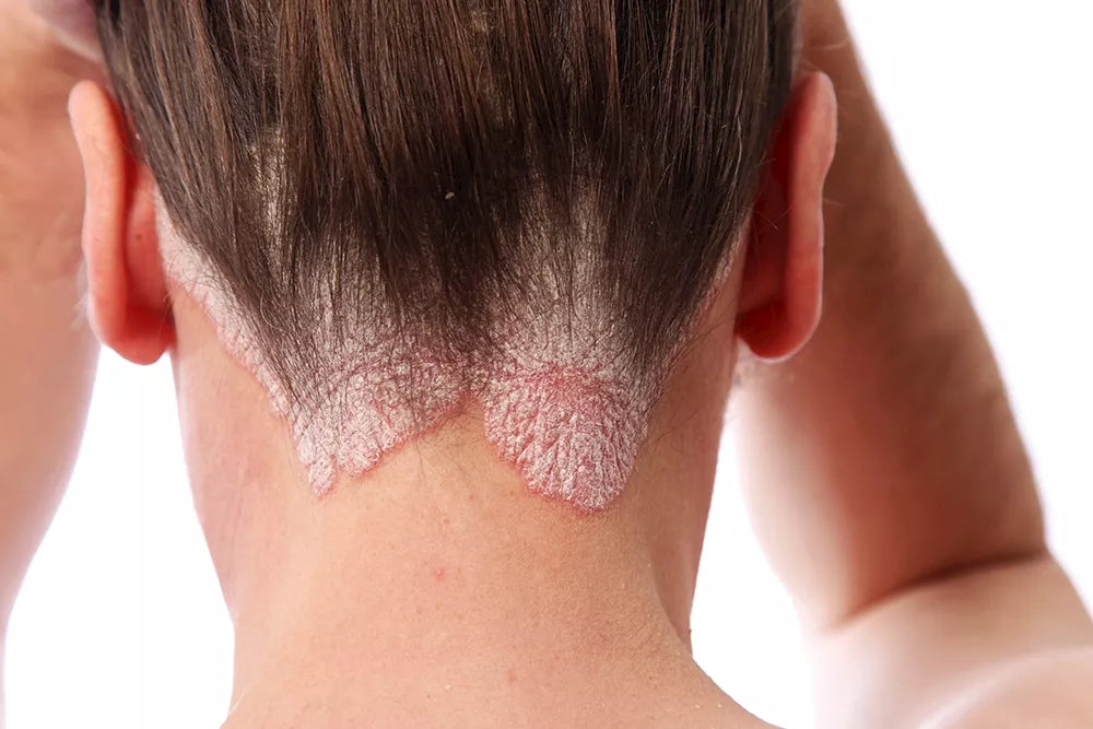 PSORIASIS: WHAT IS IT AND WHAT CAN YOU DO ABOUT IT?