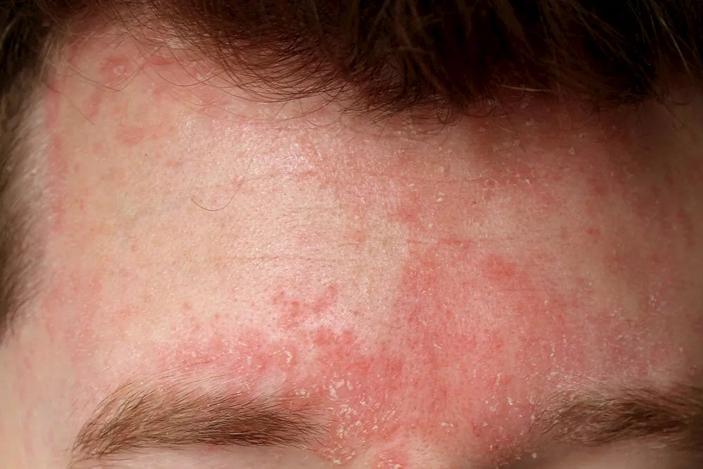 SEBORRHEIC DERMATITIS: WHAT IS IT AND WHAT CAN YOU DO ABOUT IT?