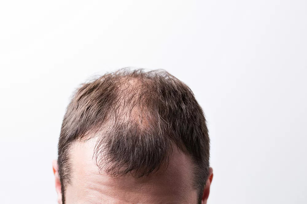 ANDROGENETIC ALOPECIA: HAIR LOSS AND BALDNESS DUE TO A HEREDITARY CAUSE