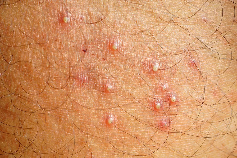 FOLLICULITIS: INFLAMMATION OF THE HAIR FOLLICLES