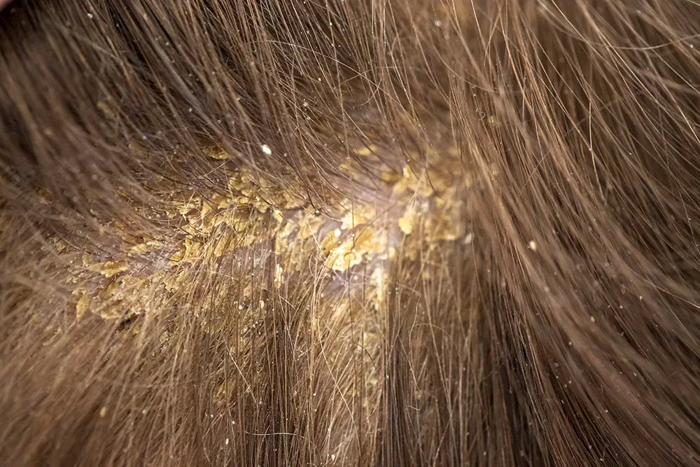 FLAKES ON THE SCALP