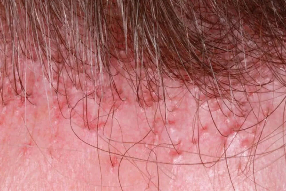 LICHEN PLANOPILARIS: HAIR LOSS DUE TO INFLAMMATION